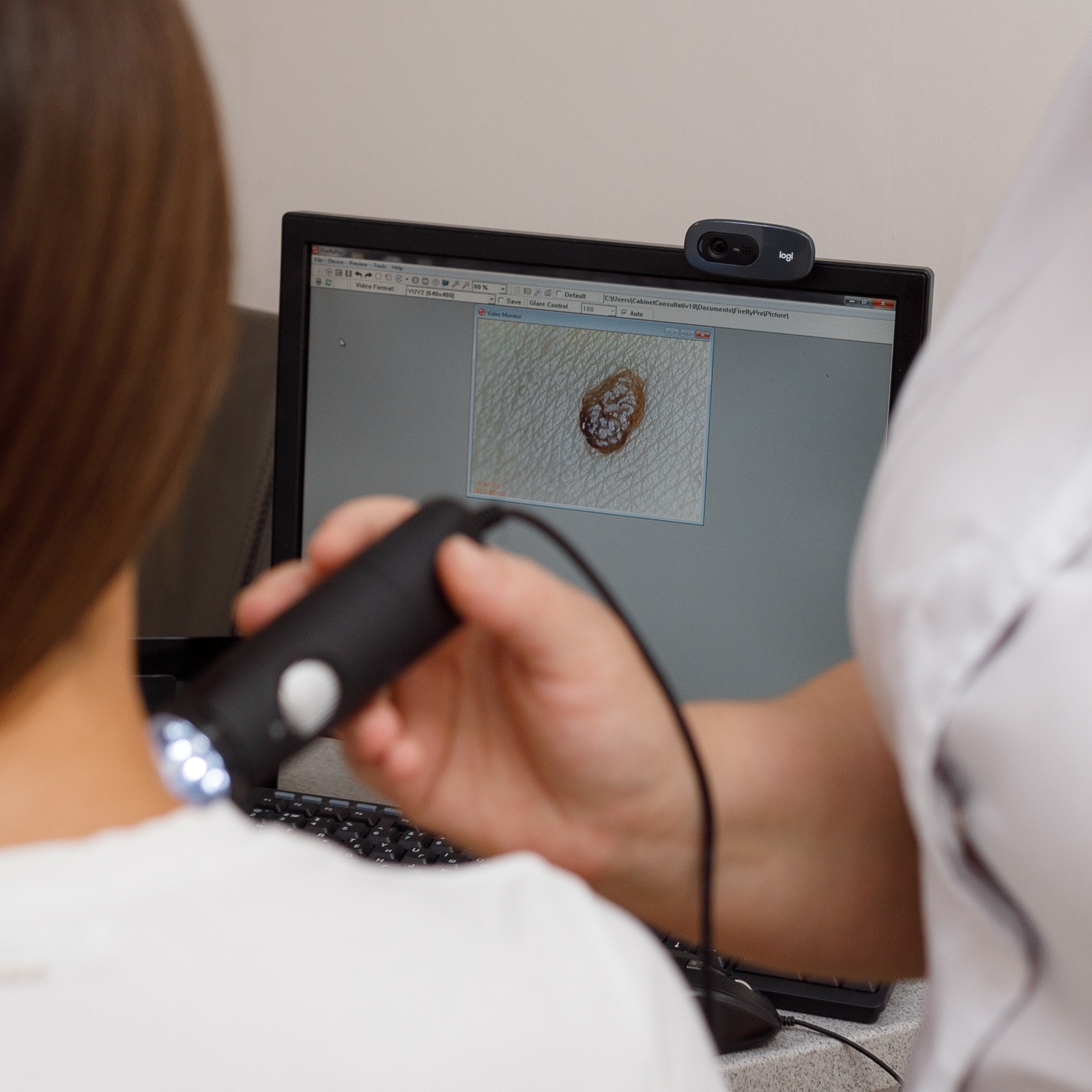 Cicatrici și sechele post-acnee