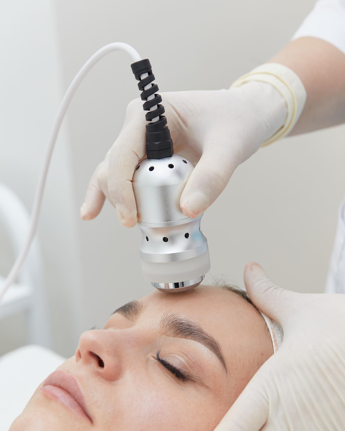  Fotona Vector Lift - rejuvenare zona frunții