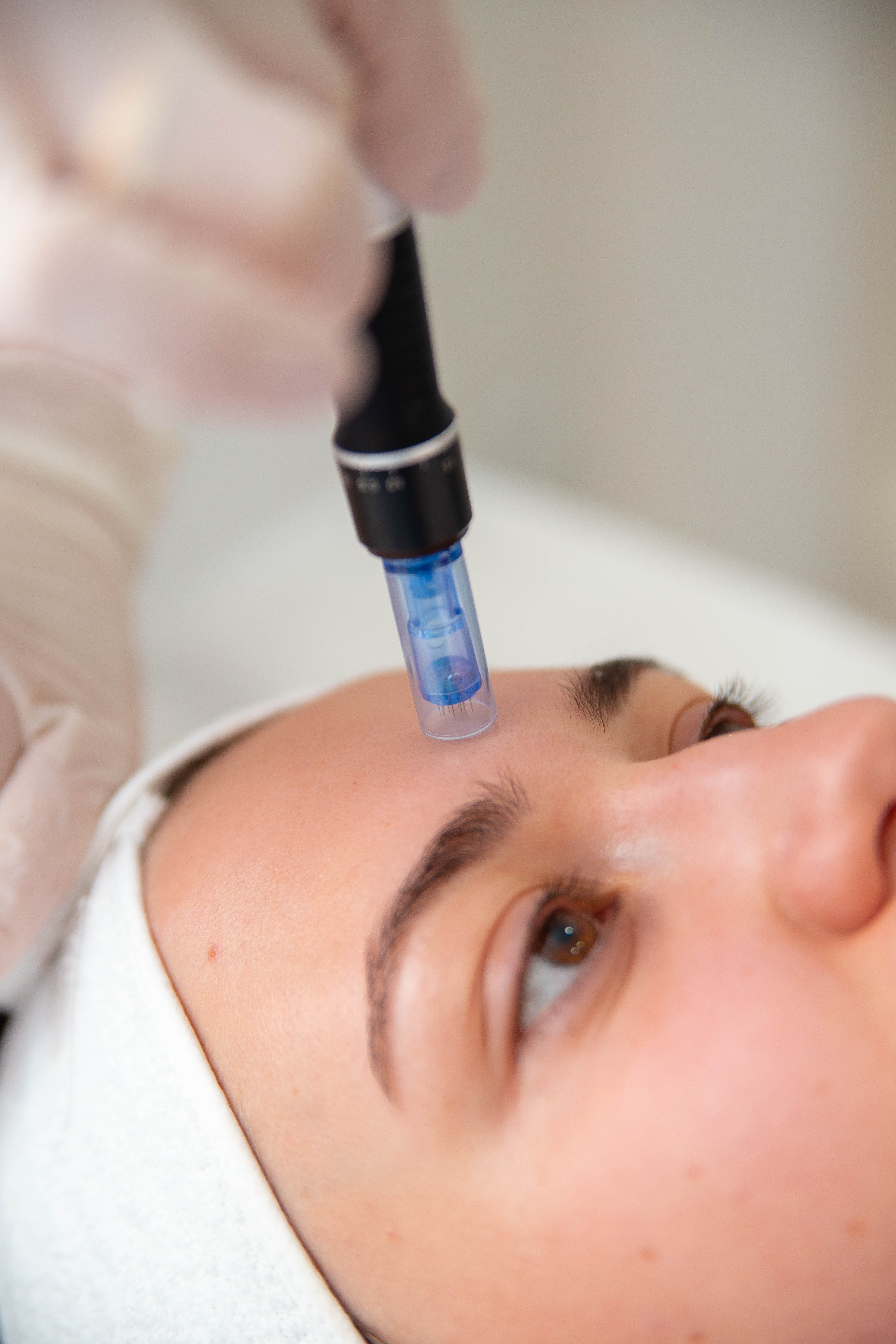 Tratamentul cu DermaPen (Microneedling)